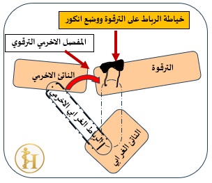 نقل الرباط الغرابي الأخرمي وتثبيته على الترقوة البعيدة والمحافظة على رد المفصل الأخرمي الترقوي 2 image 1