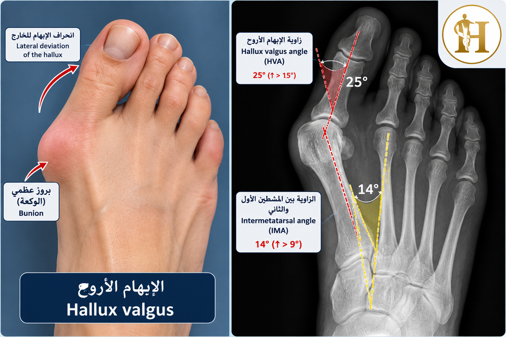(الإبهام الأروح) Hallux valgus: متى نكتفي بالعلاج المحافظ ومتى نلجأ إلى الجراحة؟ 2 (الإبهام الأروح) Hallux valgus-التشريح