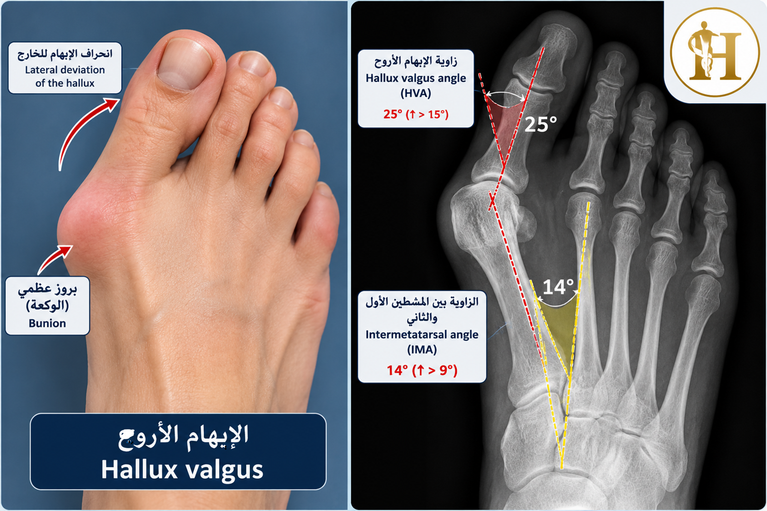 (الإبهام الأروح) Hallux valgus: متى نكتفي بالعلاج المحافظ ومتى نلجأ إلى الجراحة؟ 1 image 10