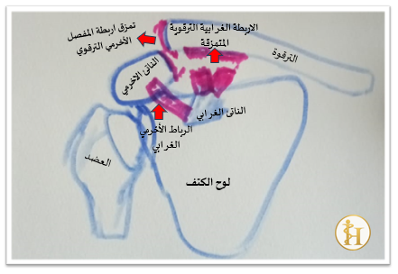إصابة المفصل الأخرمي الترقوي: هل الصفيحة الخطافية أفضل من الأسياخ والأسلاك؟ 3 image 4