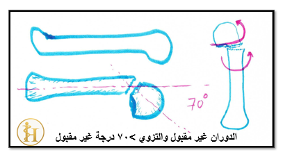 كسر عنق المشط الخامس (كسر البوكس): العلاج المحافظ أم الجراحة؟ 2 كسر عنق المشط الخامس(كسر البوكس)-استطباب الجراحة