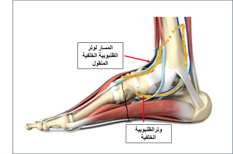 نقل وتر الظنبوبية الخلفية لعلاج هبوط القدم بعد إصابة العصب الشظوي العميق 3 image 9
