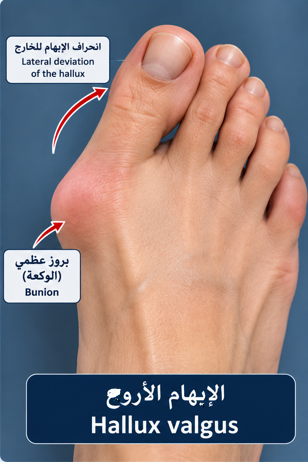 الإبهام الأروح هل أحتاج إلى عملية ؟ 2 هل أحتاج إلى عملية للإبهام الأروح؟